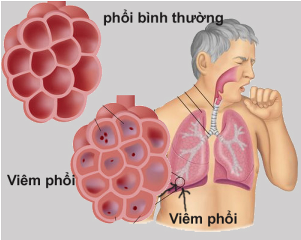 PHÒNG NGỪA LÂY NHIỄM  BỆNH VIÊM PHỔI NẶNG DO VI RÚT (SVP)