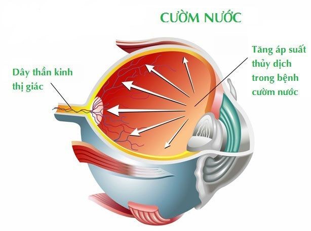 HƯỞNG ỨNG NGÀY GLAUCOMA THẾ GIỚI  (TỪ NGÀY 09/3/2025-15/3/2025) “Bảo Vệ Thị Lực Của Bạn