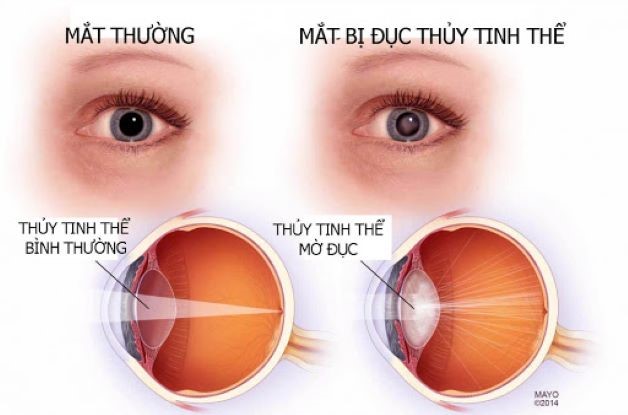 ĐỤC THỦY TINH THỂ