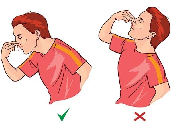 HƯỚNG DẪN XỬ TRÍ CHẢY MÁU MŨI TẠI NHÀ