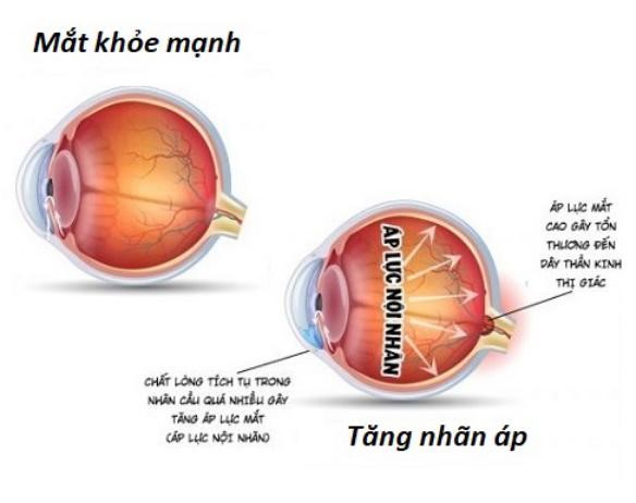 Cảnh báo Tăng nhãn áp sau chấn thương mắt - Hậu quả khó lường!