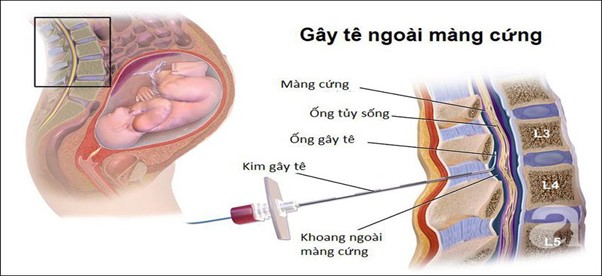 “ĐẺ KHÔNG ĐAU” BẰNG PHƯƠNG PHÁP  GÂY TÊ NGOÀI MÀNG CỨNG