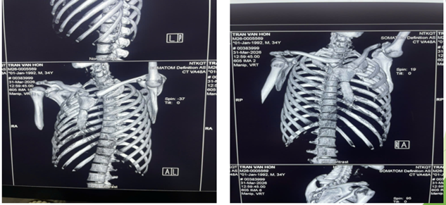 XỬ LÝ THÀNH CÔNG CA BỆNH GÃY ĐỒNG THỜI ĐẦU TRONG VÀ ĐẦU NGOÀI XƯƠNG ĐÒN CÙNG BÊN