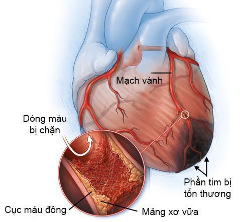 Cảnh giác với nhồi máu cơ tim ở người trẻ