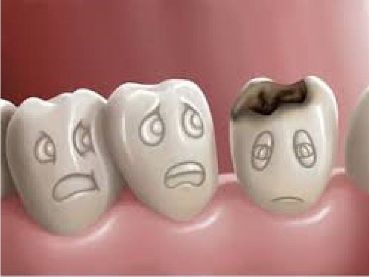 Sâu răng và  các biện pháp phòng ngừa