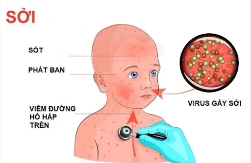 Hướng dẫn chăm sóc và theo dõi trẻ mắc bệnh sởi