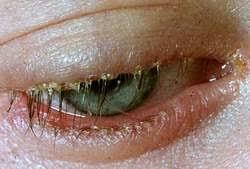 Bệnh viêm bờ mi mạn