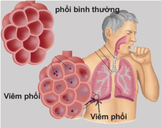 phong ngua lay nhiem  benh viem phoi nang do vi rut svp