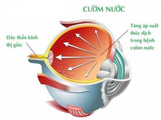 huong ung ngay glaucoma the gioi  tu ngay 0932025 1532025 “bao ve thi luc cua ban