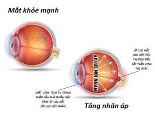 canh bao tang nhan ap sau chan thuong mat   hau qua kho luong!