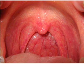 huong dan tu van giao duc suc khoe viem amidan