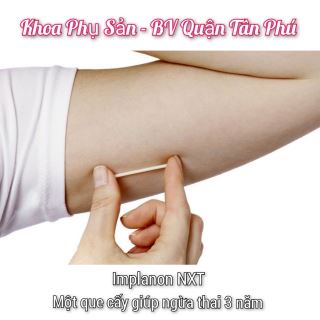 que cay tranh thai implanon nxt va nhung dieu can biet