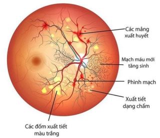 benh vong mac dai thao duong