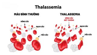 thalassemia benh tan mau bam sinh nguy hiem nhung co the phong ngua